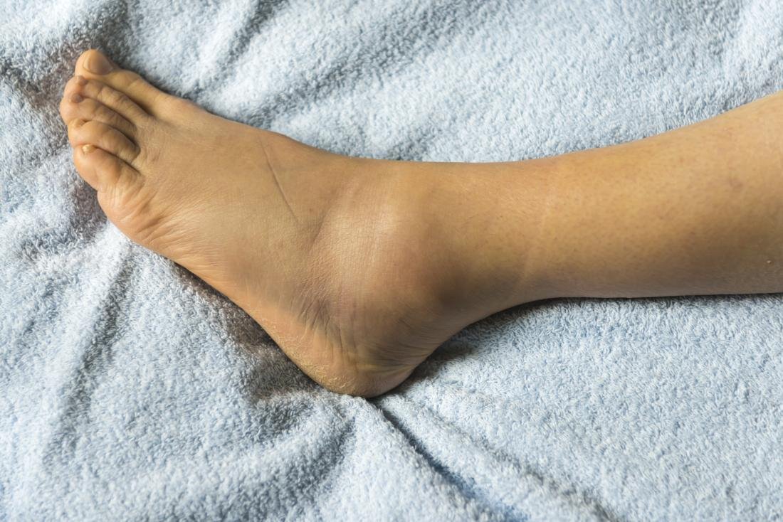 What Causes Feet Pain And Swelling