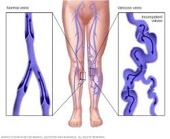 Varicose veins Treatment in Noida