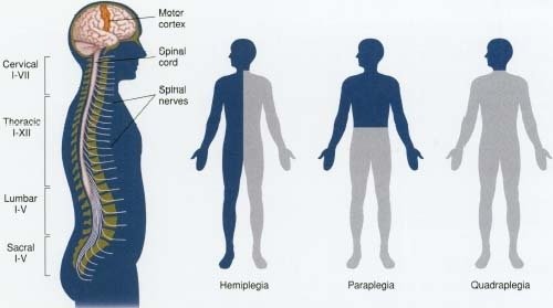 paralysis-stroke-hemiplegia-treatment-in-noida-delhi-ncr-india