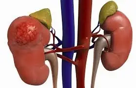 Kidney Problems