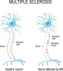 Multiple Sclerosis