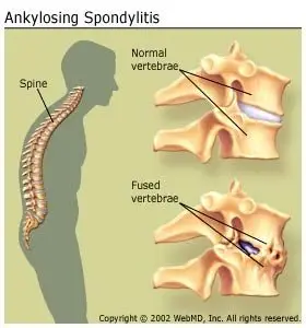 Spinal Ankylosis